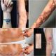 Tatouage des cicatrices: peser le pour et le contre