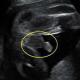 Ko je na ultrazvočnem pregledu natančno določen spol otroka in ali se lahko zdravnik zmoti Kateri spol otroka se na ultrazvoku pokaže hitreje