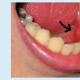 Rak pustej jamy ustnej - jak diagnozować, leczyć i zapobiegać pojawieniu się nowego złośliwego tworu